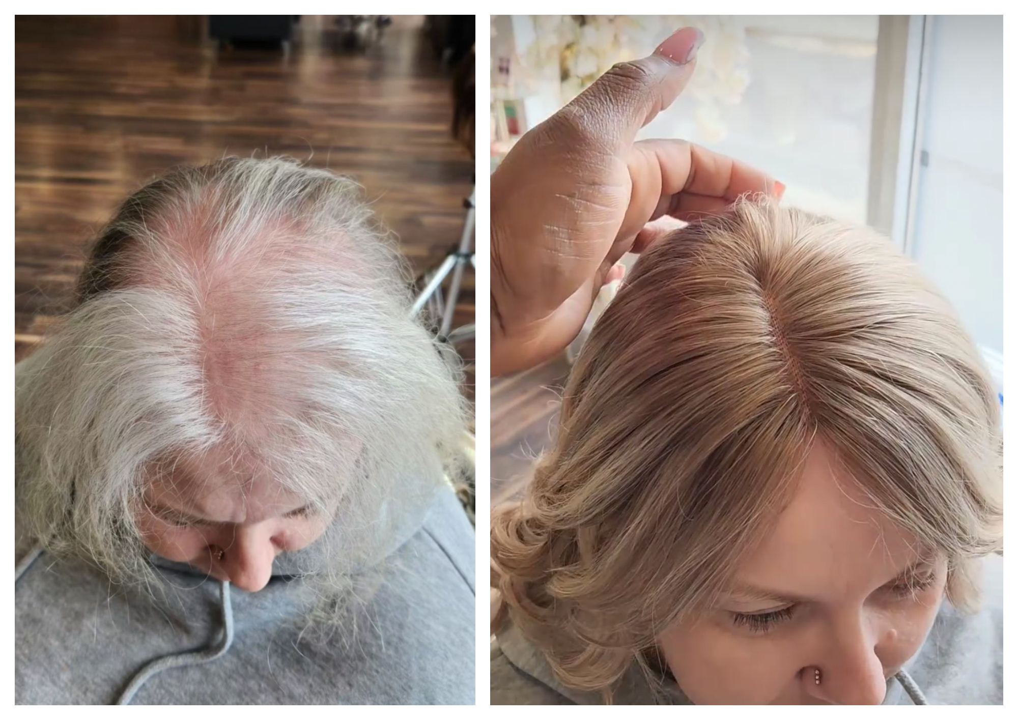 A genuine iHobbs client shown before and after Crown Integration hair replacement